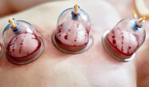 Best Cupping Therapist in Jaipur