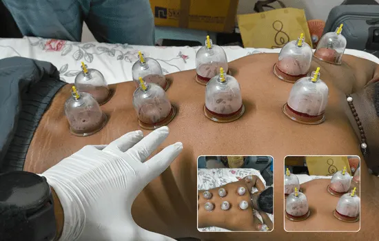 Cupping or Hijama Therapy in Jaipur