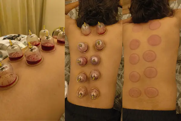 Home Cupping Therapy in Jaipur
