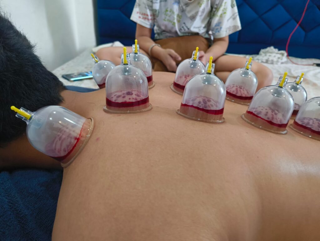 Cupping Therapy Session