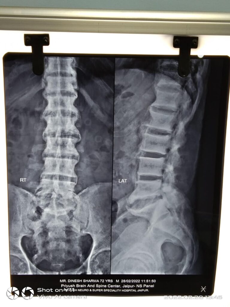 LS Spine X-ray