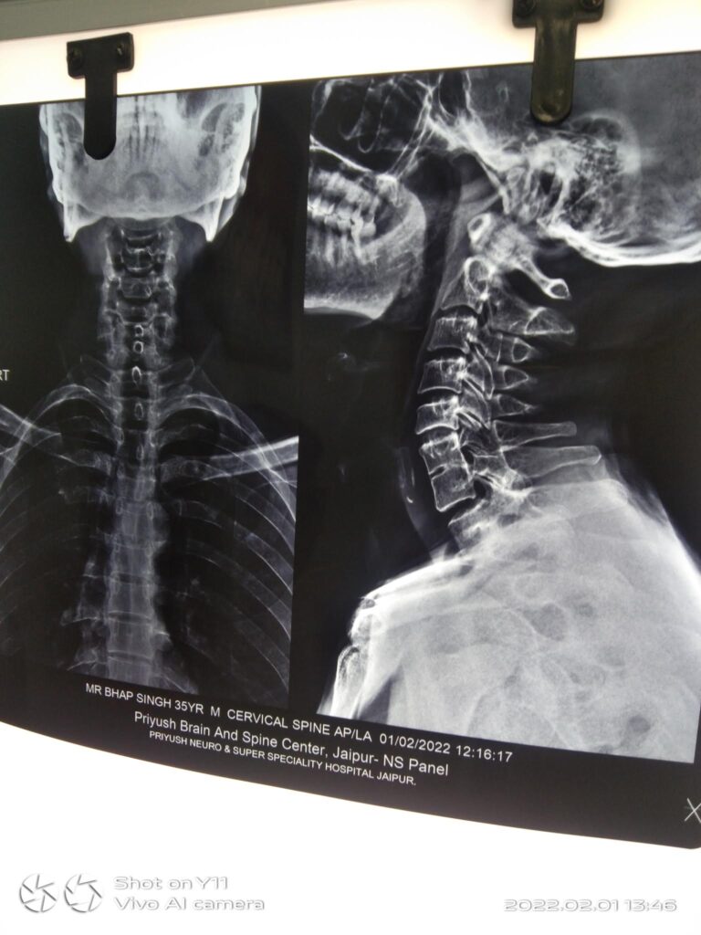 cervical x-ray