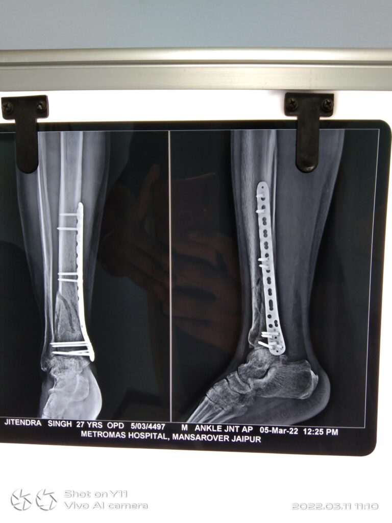 leg x-ray