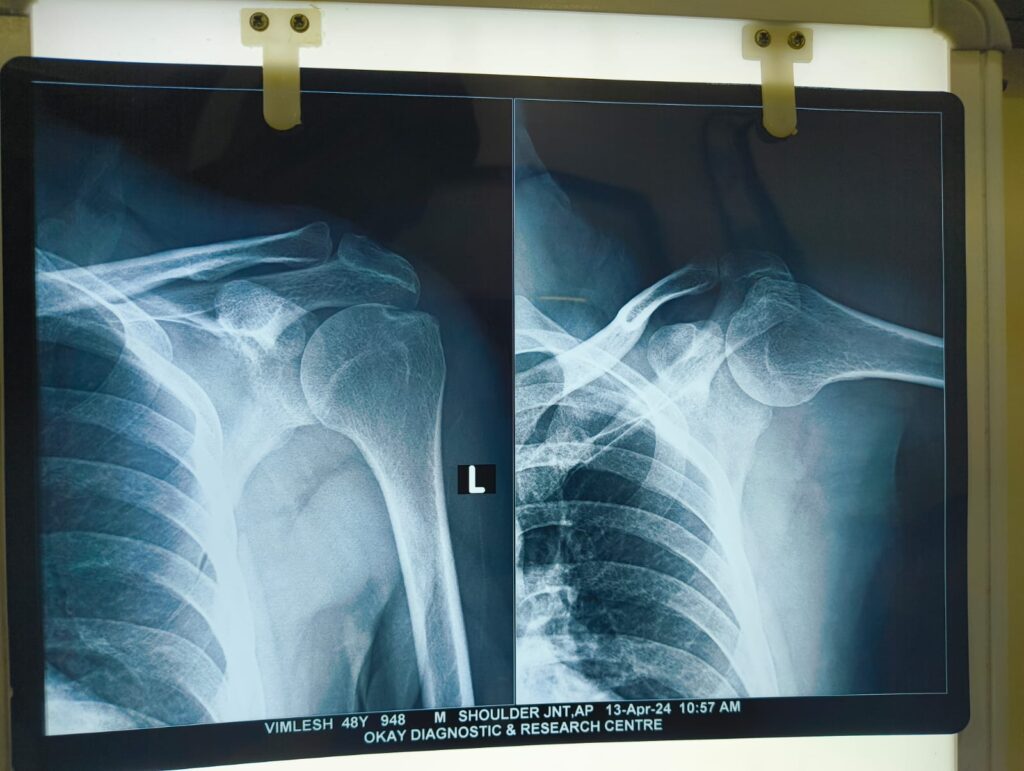 shoulder x-ray